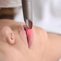 Laser Fotona 4D : Effet lift naturel sans chirurgie à Garches