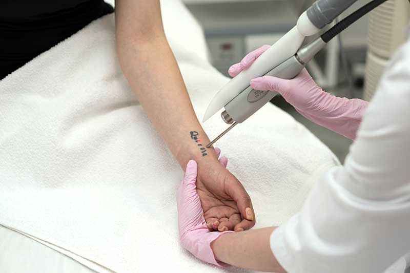 Détatouage au laser à Garches chez le dr Herz