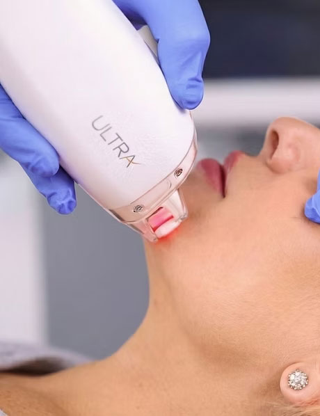Laser LaseMD Ultra® à Garches Hauts de Seine