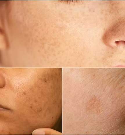 Taches de la peau au laser à Garches chez le dr Herz